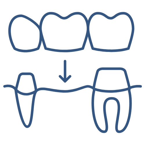 Dental Bridge - Smile 64 Clayton Dental