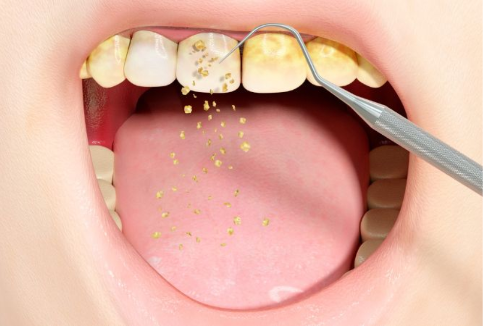 Teeth Cleaning Treatment in Surrey