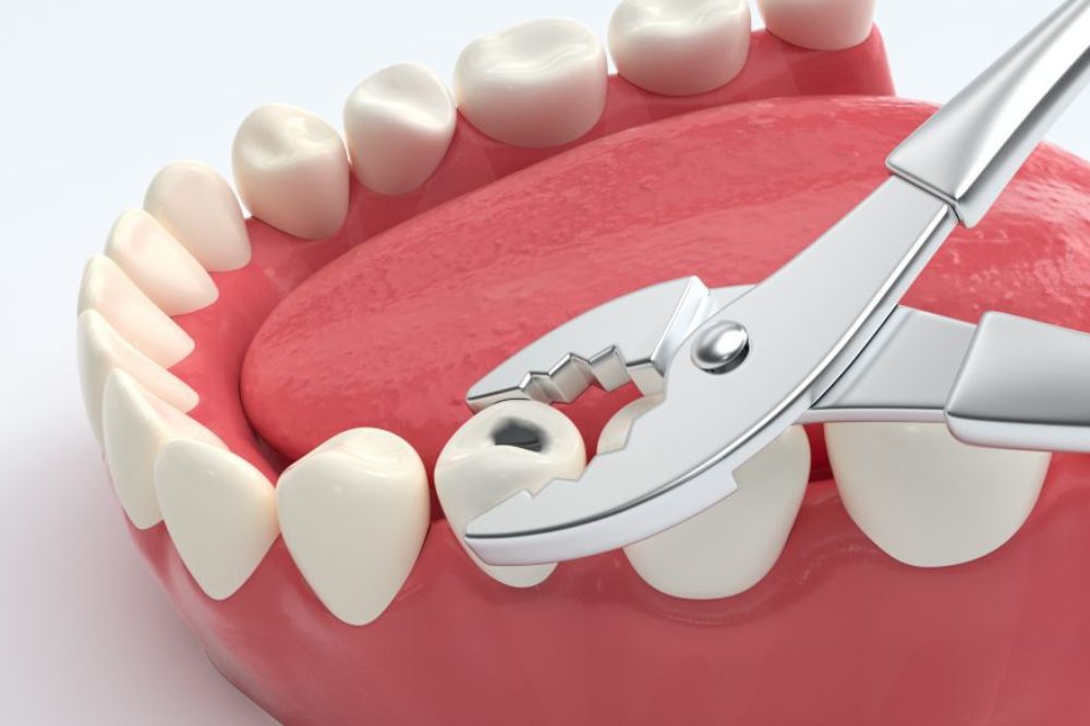 Tooth extraction in Surrey