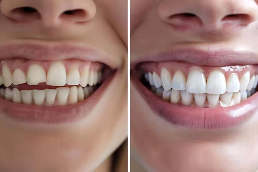 Before and after Invisalign smile transformation