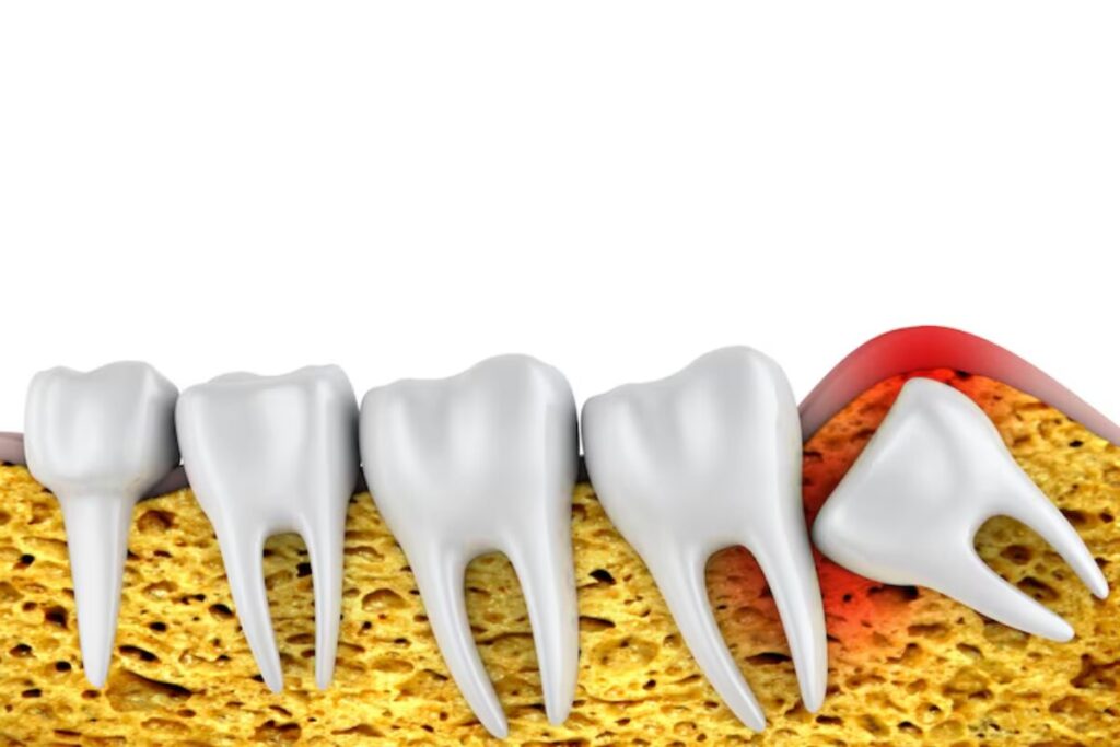 Wisdom tooth extraction recovery
