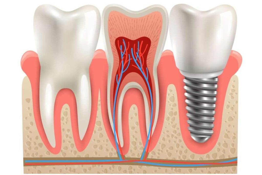 root canal vs implant