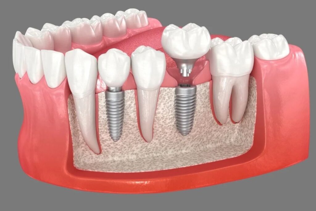 how many years will a dental bridge last
